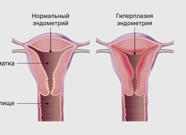 Эндометрий однородный что это значит