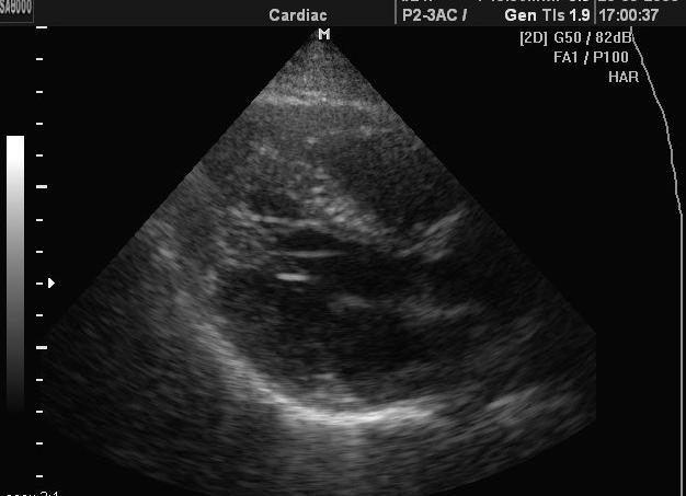 Дополнительная трабекула левого желудочка у ребенка