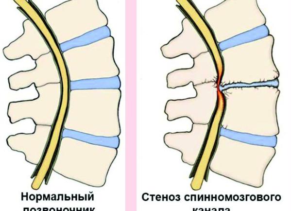 Что такое стеноз позвоночного канала