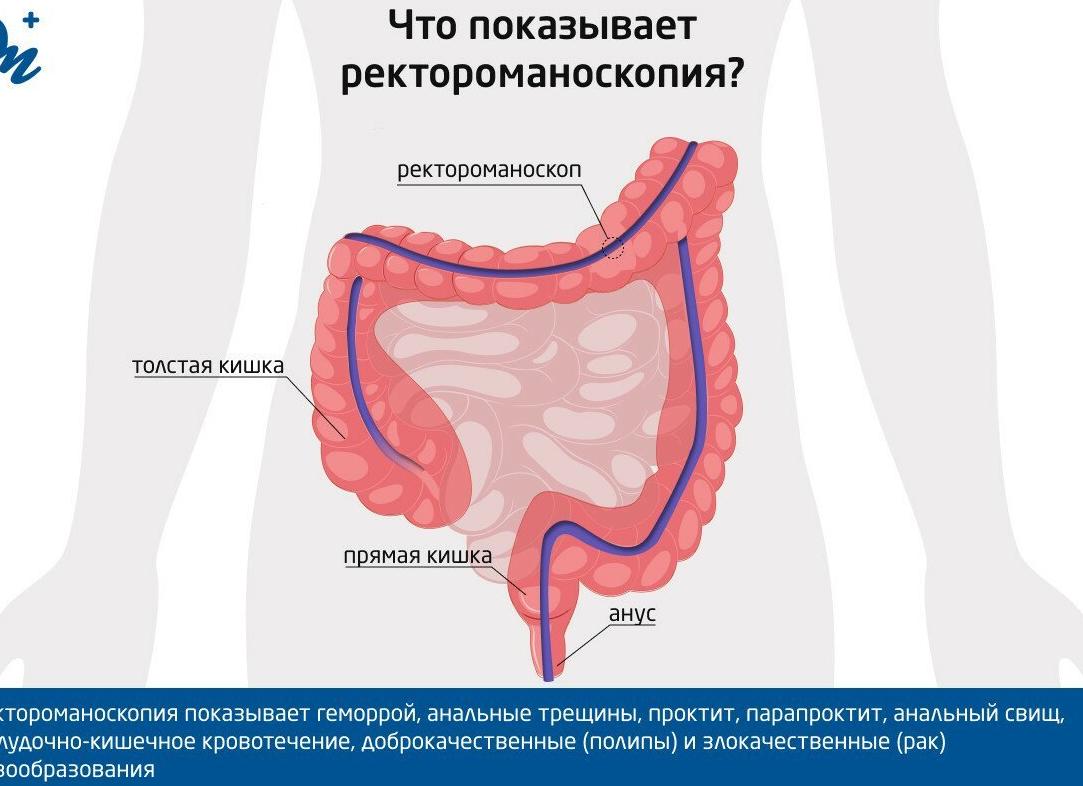 Что показывает ректороманоскопия