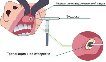 Киста верхней челюстной пазухи