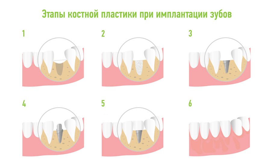Костные пластинки это
