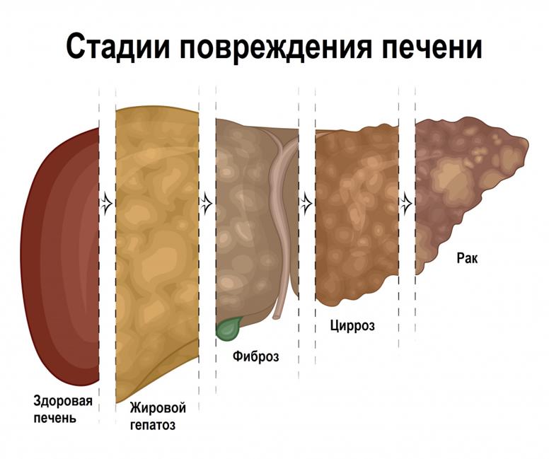 Может ли показать узи печени цирроз