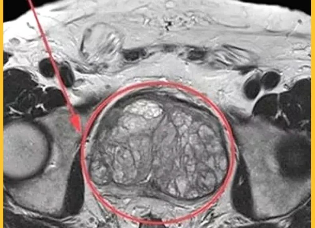Мрт аденомы простаты