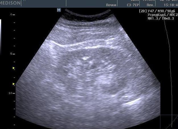 Микрокалькулез почек что это такое