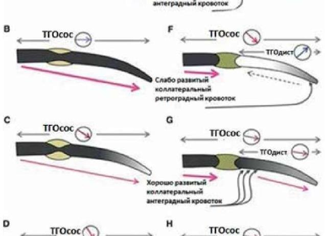 Кровоток антеградный в позвоночной артерии что это Кровоток антеградный в позвоночной артерии что это