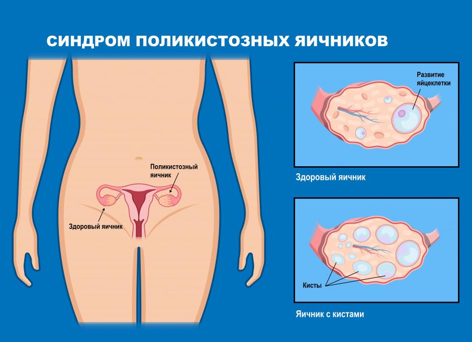 Как повысить гормон лютеинизирующий