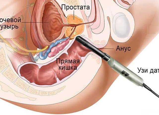 Как делают узи простаты у мужчин