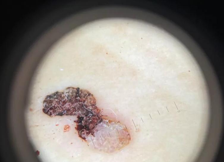 Если травмировал родинку что делать