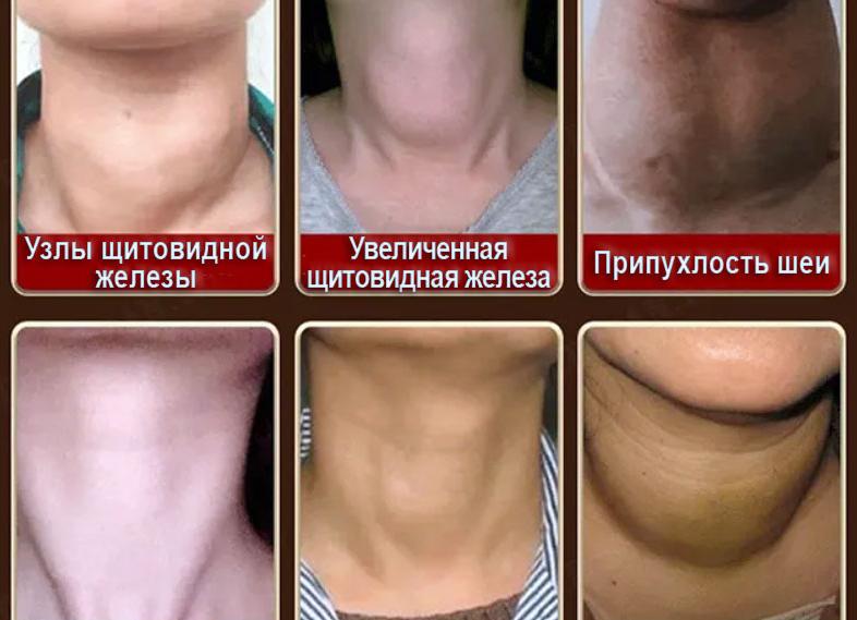 Если щитовидка увеличена