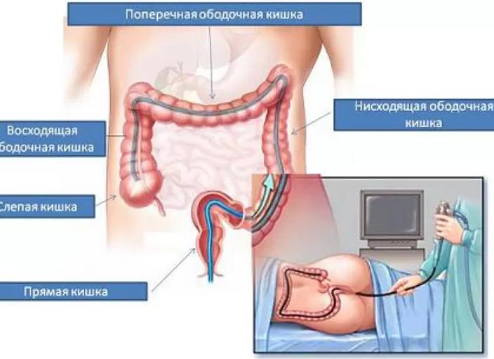 Что выявляет колоноскопия кишечника