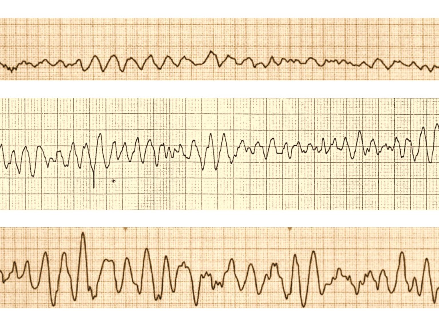 Что такое фибрилляция желудочков