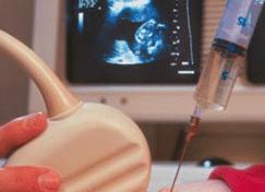 Что такое амниоцентез