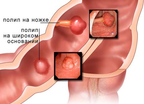 Что это полип Что это полип