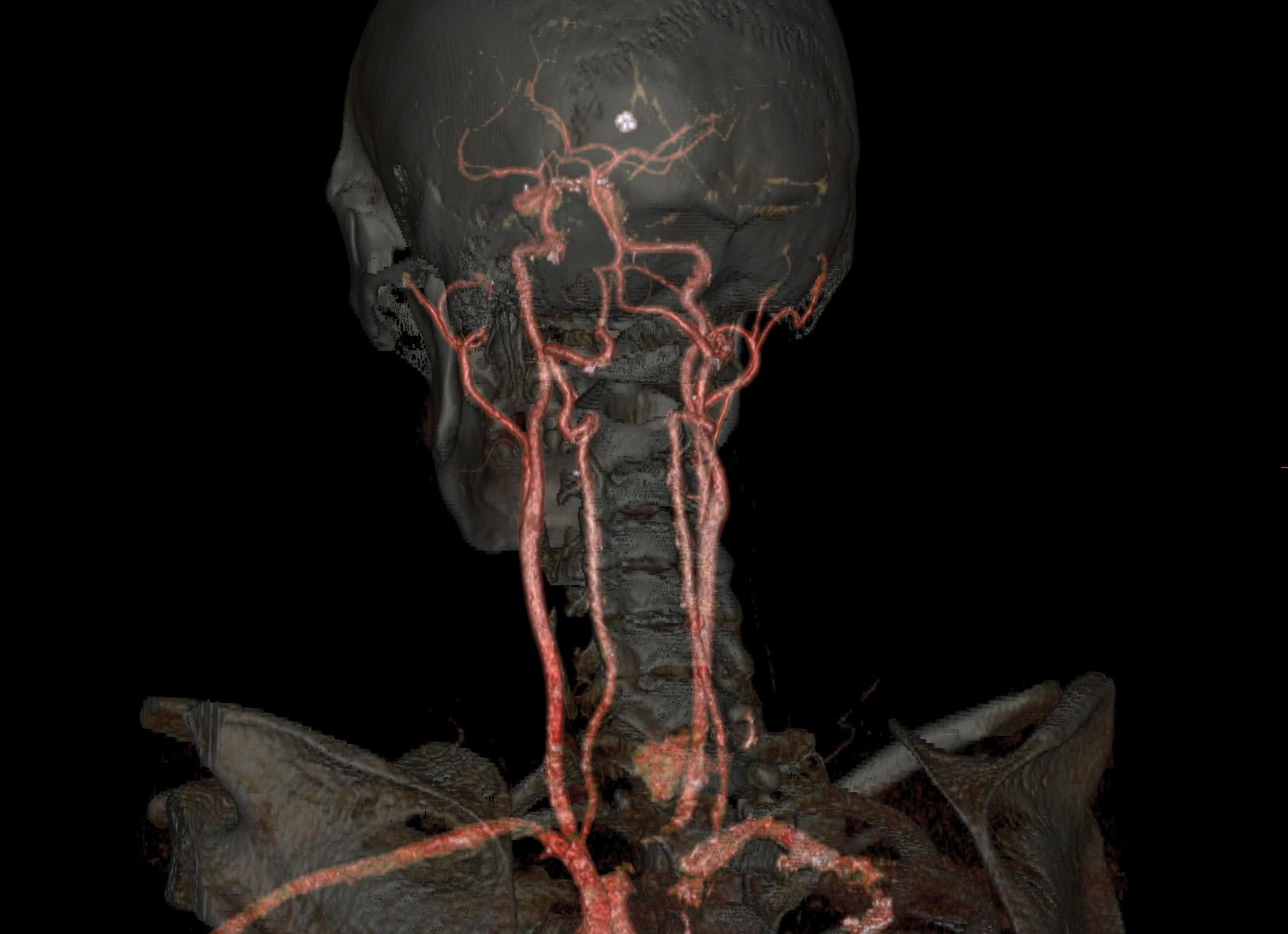 Ангиография артерий шеи