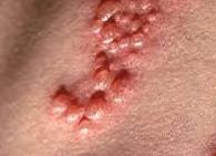 Анализы на герпес 1 и 2 типа