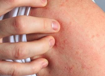 Аллергия на запахи