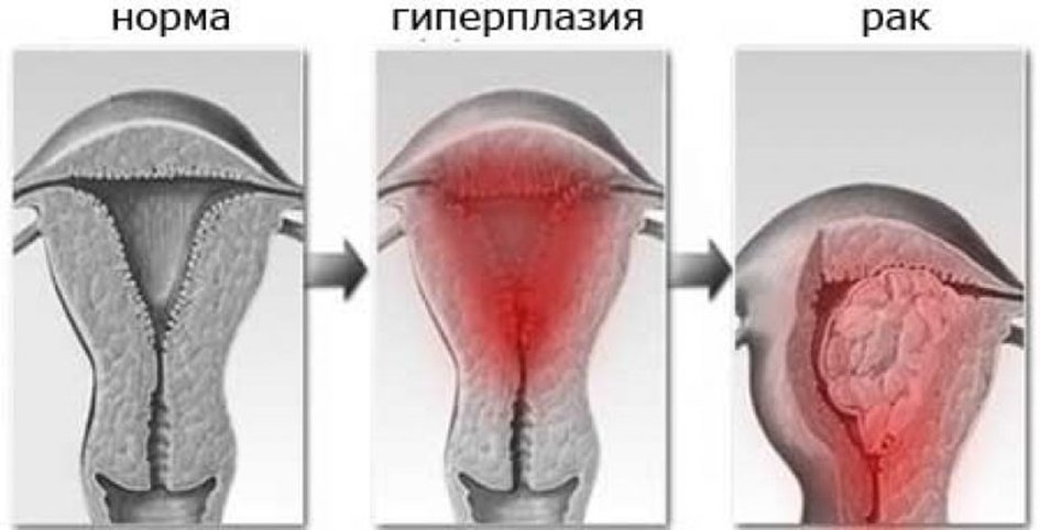 Гиперплазия эндометрия в постменопаузе норма