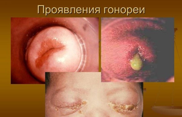 Гонорея это у мужчин