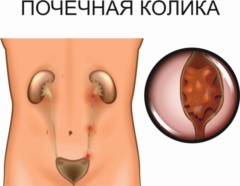 Колики в почках