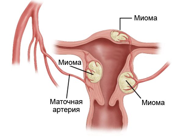 Миома матки фотографии