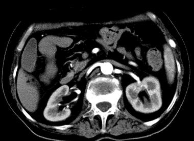Компьютерная томография почек Компьютерная томография почек
