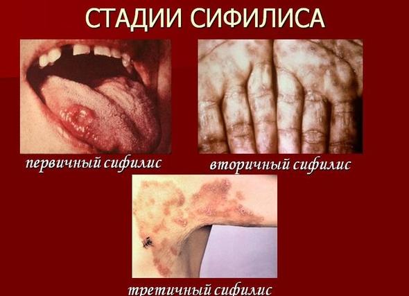 Как обозначается сифилис