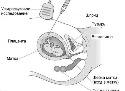 Как делают узи первый скрининг