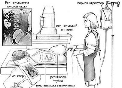 Как делают ирригоскопию Как делают ирригоскопию