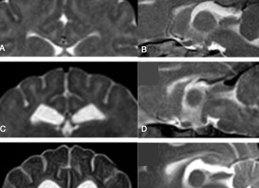 Гипоплазия мозолистого тела головного мозга у ребенка Гипоплазия мозолистого тела головного мозга у ребенка