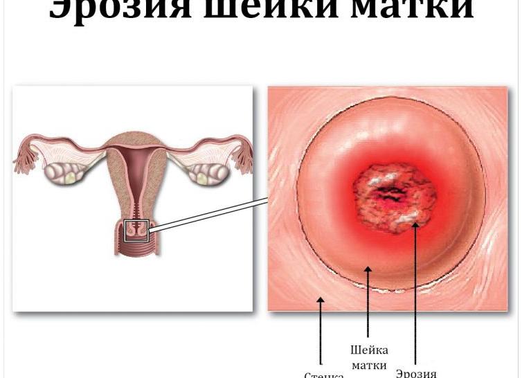 Эрозия шейки матки кровит что делать