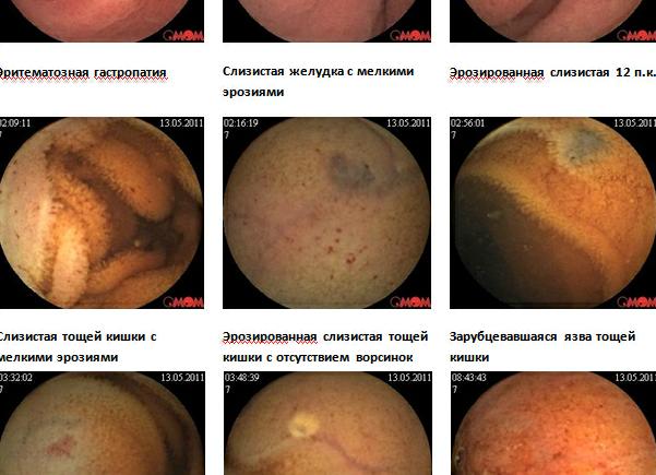 Эритематозная проксимальная дуоденопатия