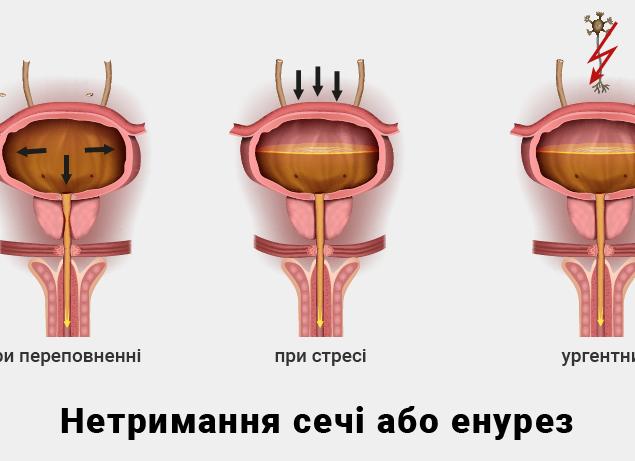 Энурез что это такое