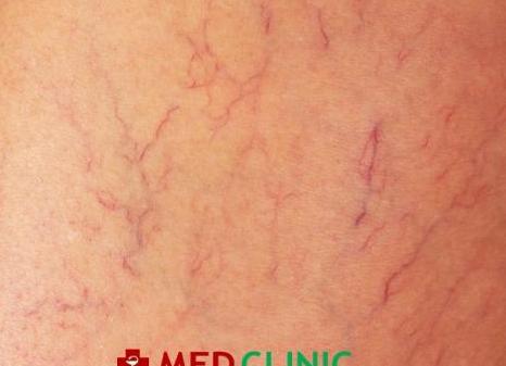 Что такое густая кровь у человека как определить