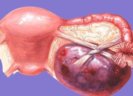 Что будет если кисту яичника не удалять