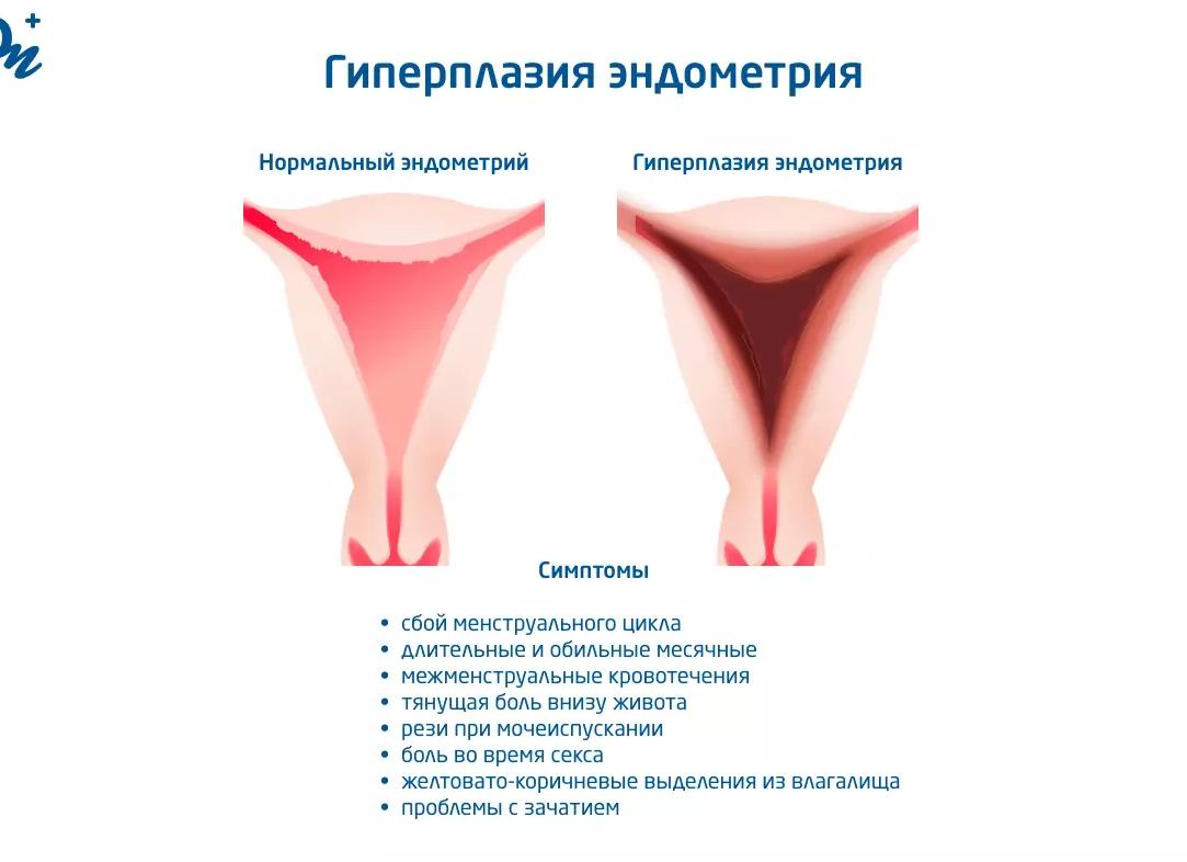 Чем опасна гиперплазия эндометрия в период менопаузы