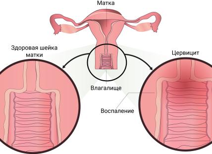 Белые выделения с запахом лука Белые выделения с запахом лука