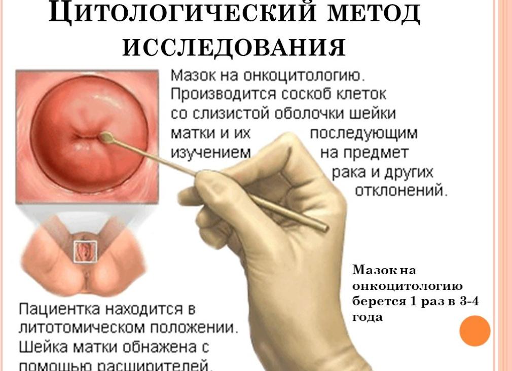 Анализ мазка на цитологию