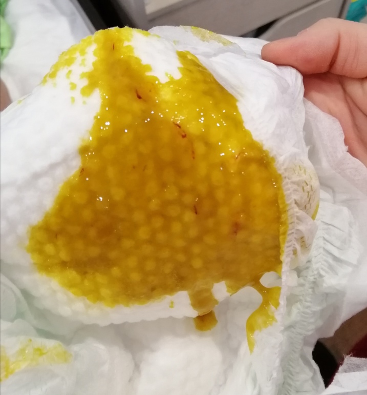 Капельки крови в кале у грудничка