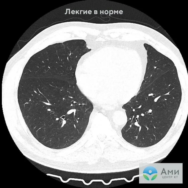 Кт норма легких