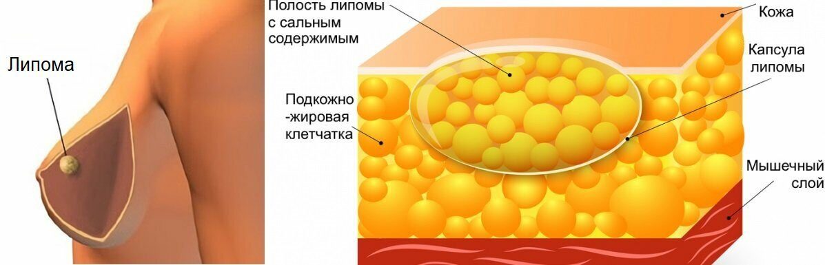 Липома молочной железы