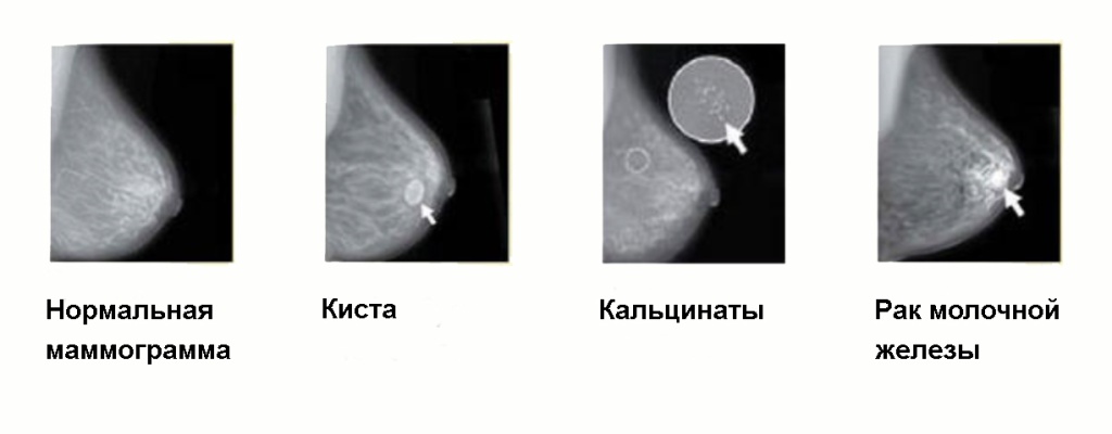 Маммограмма молочных желез