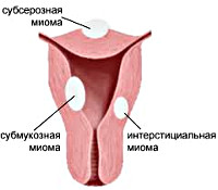 Миома матки интерстициальная форма
