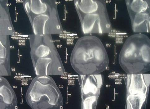 Мрт коленного сустава или узи что лучше