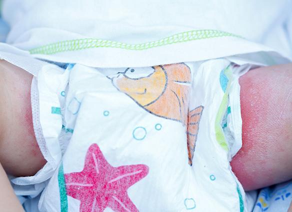 Молочница у грудничка в паху фото Молочница у грудничка в паху фото