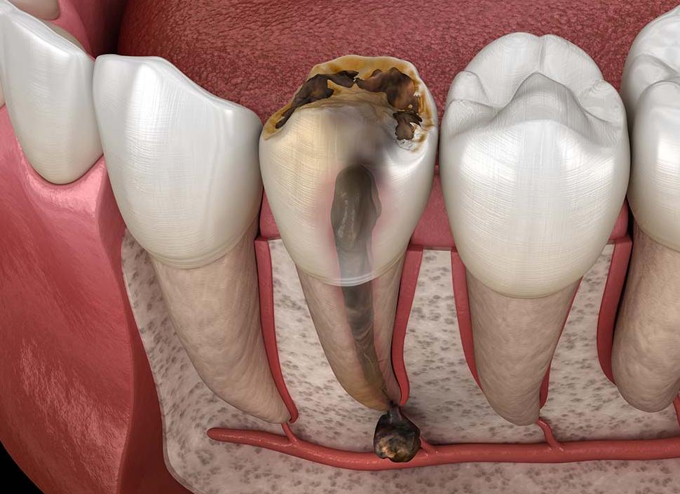 Киста как ее лечить и что такое