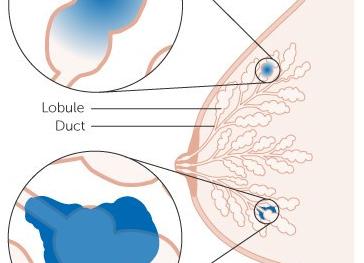 Инфильтрирующий рак молочной железы