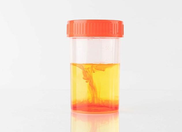 Если в моче эритроциты