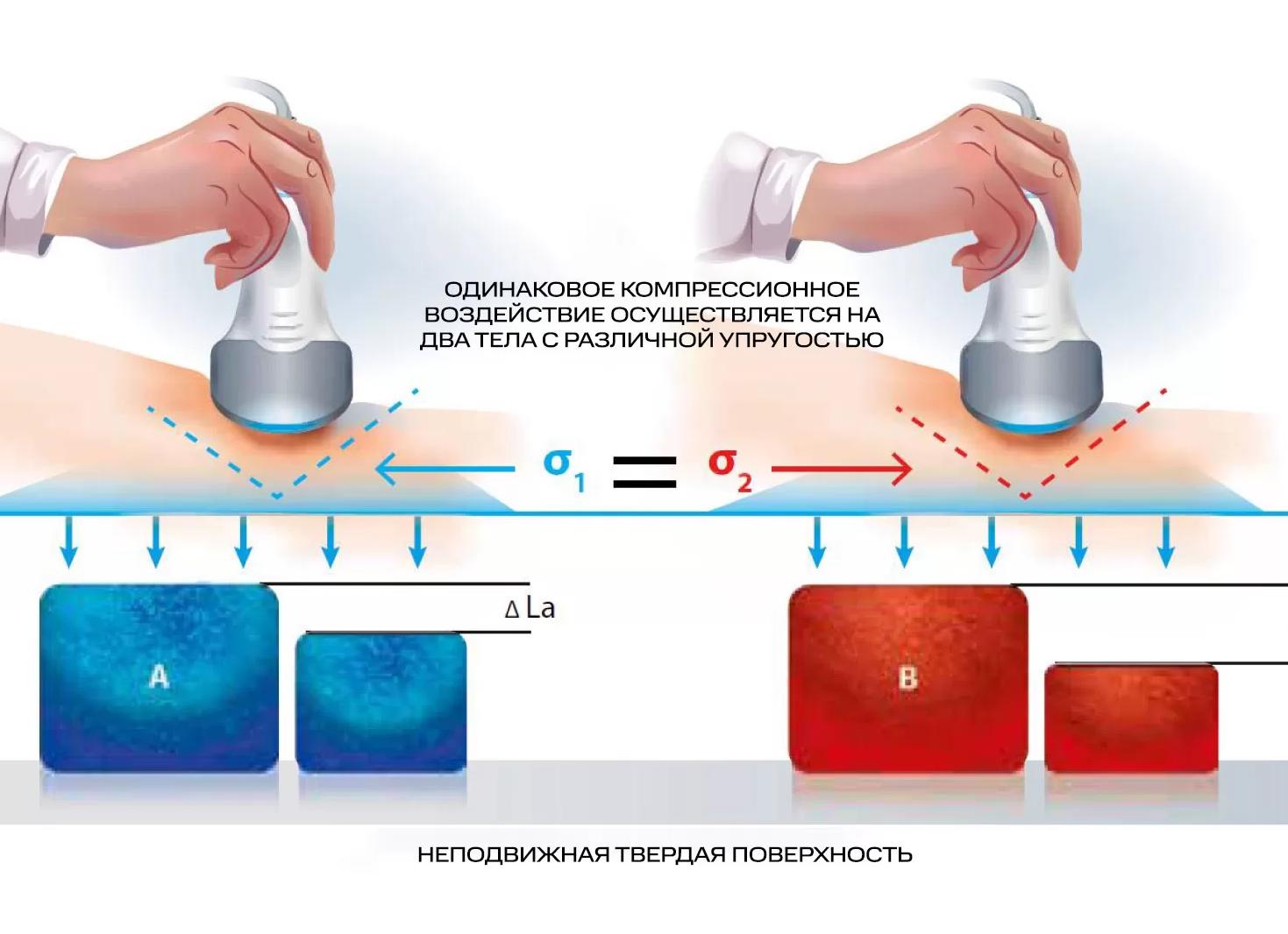 Эластография что это такое