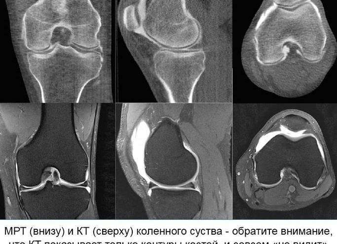 Что показывает мрт колена